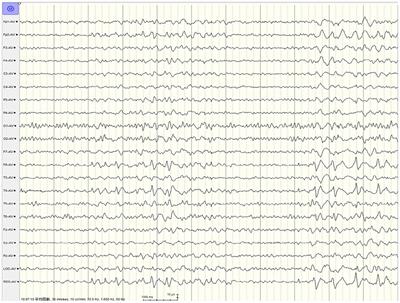 Comparison of Electroencephalography in Patients With Seizures Caused by Neurosyphilis and Viral Encephalitis